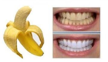 Buccia di Banana: Sbiancante per denti