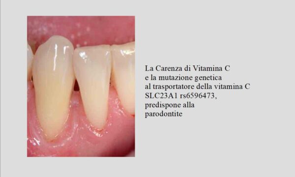 Carenza di Vitamina C e Parodontite
