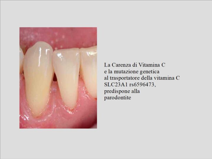 Carenza di Vitamina C e Parodontite